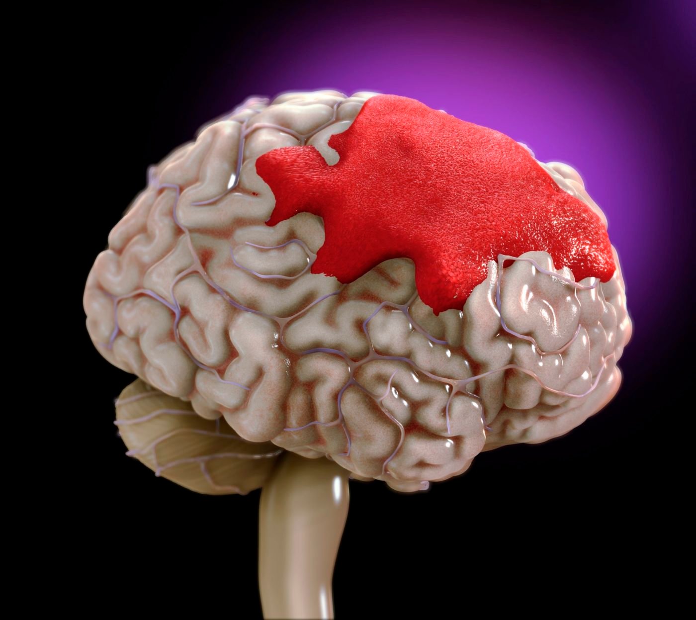 Intracerebral Brain Haemorrhage