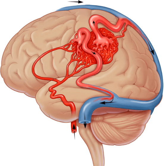 Cerebral Arteriovenous Malformation (AVM)