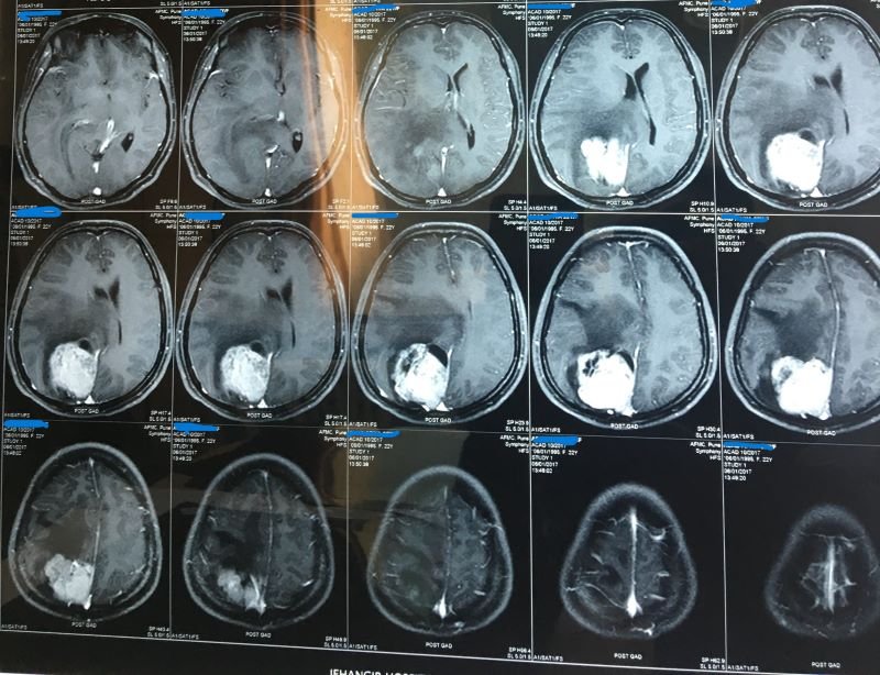 MRI of Brain Tumor