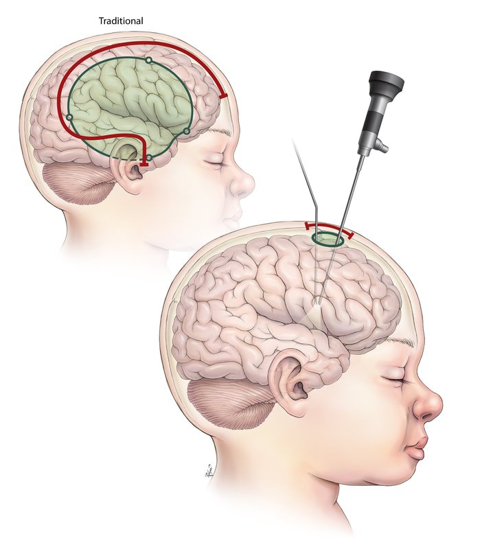 Epilepsy Surgery Setup