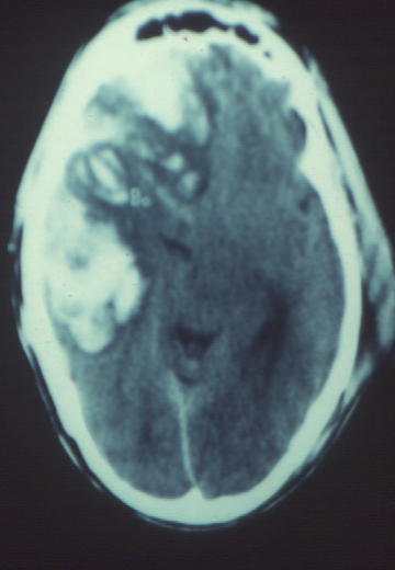 CT Scan of Severe Head Injury