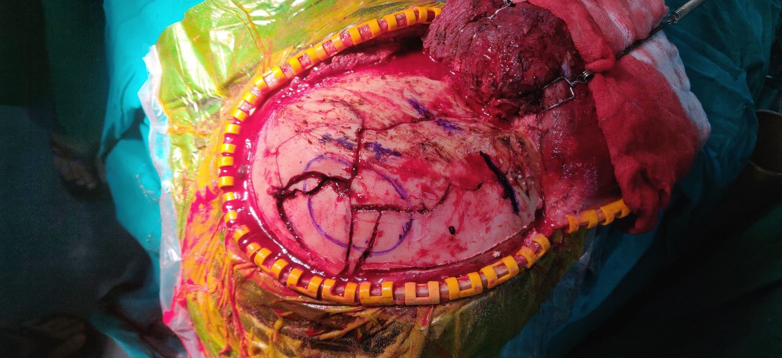 Head Injury