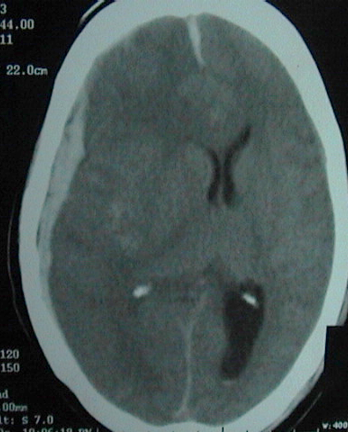 Acute Sub Dural Haematoma