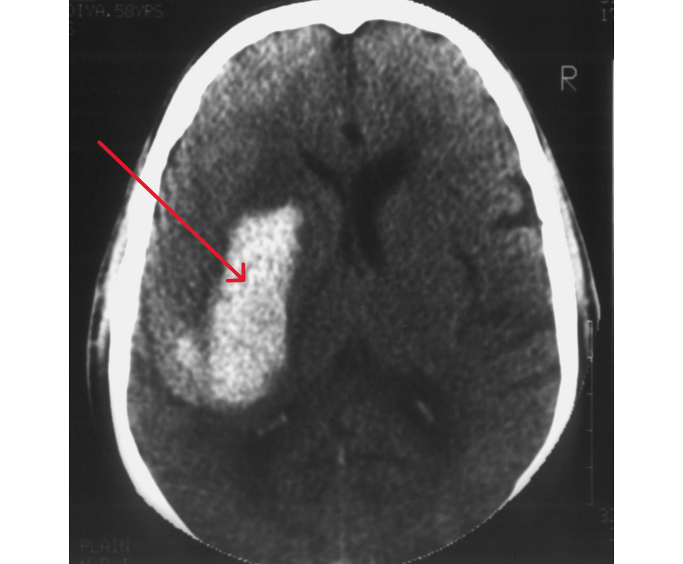 brain haemorrhage Noted on the Right Side OF Brain