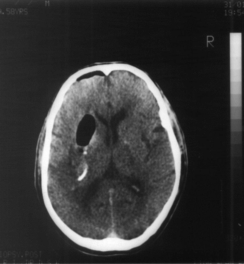 Scan after aspiration of blood clot