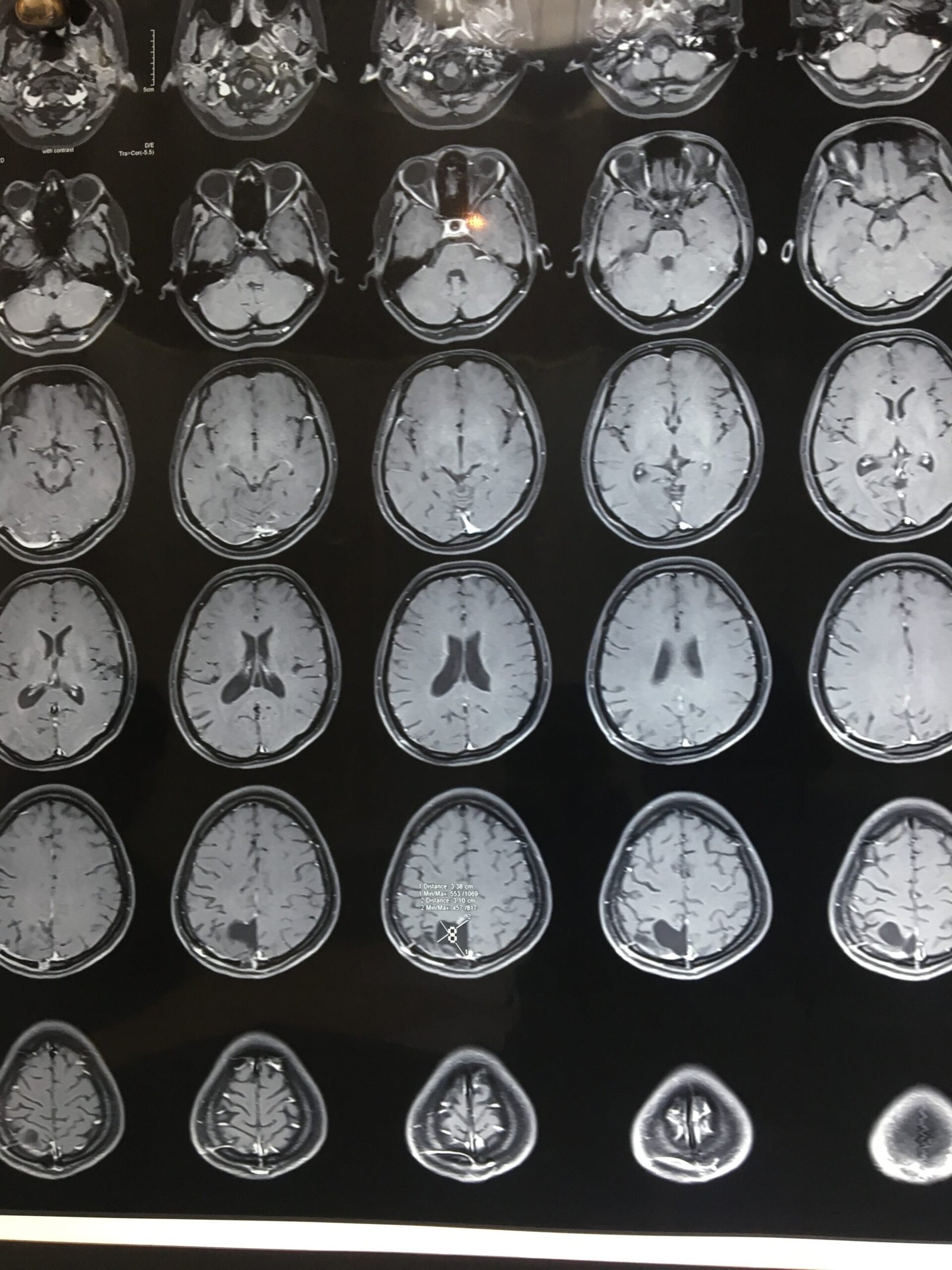 CT Scan After SURGERY