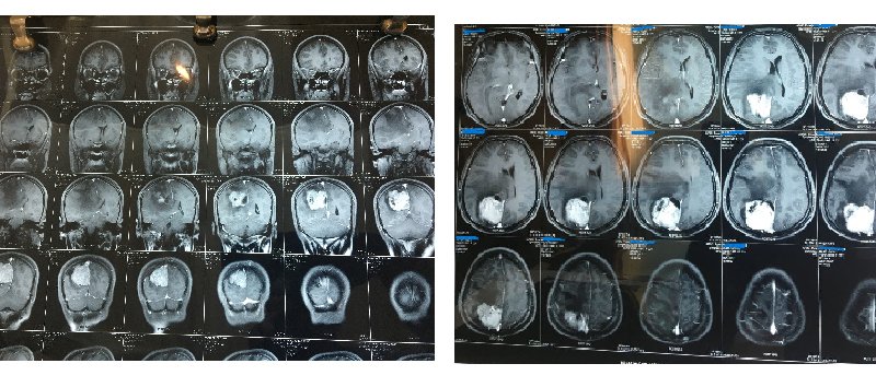 BRAIN TUMOR Before SURGERY