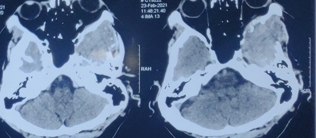 Post Operative Images after removal of metastasis