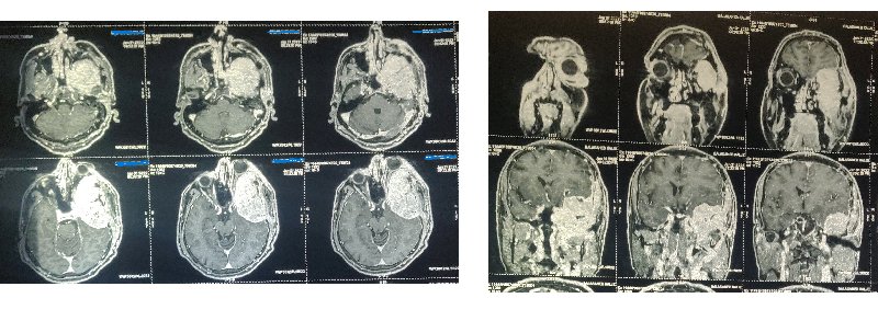 Tumour behind the eye due to Metastasis from the thyroid gland