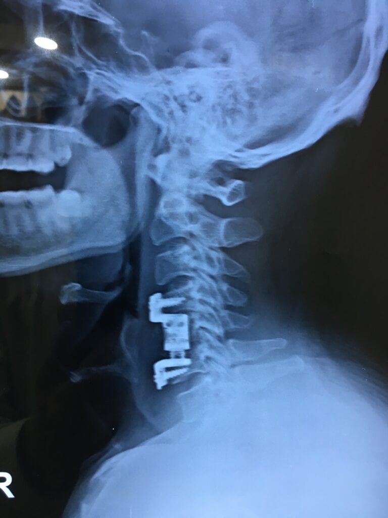 Stabilization done in spinal cord injury