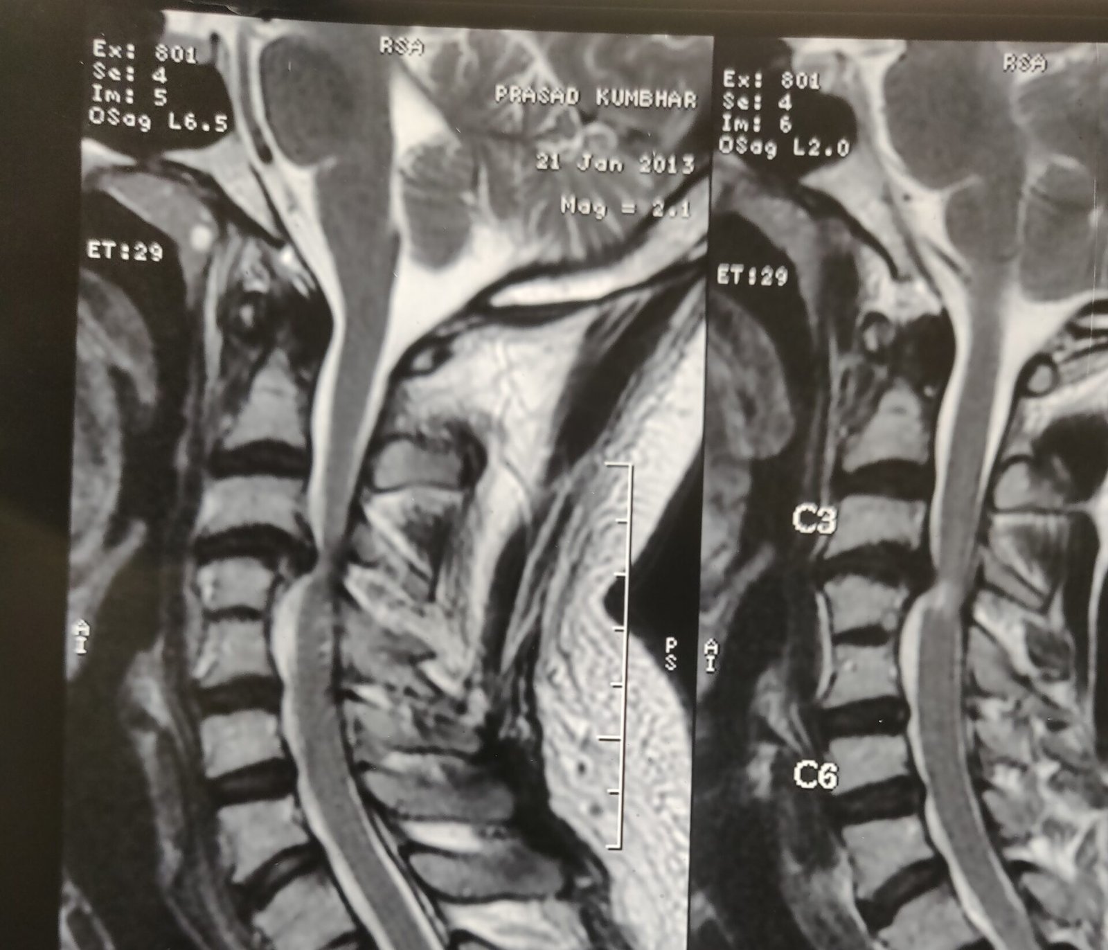 CERVICAL DISC Prolapse AT C3-C4 LEVEL CAUSING SPINAL CORD COMPRESSION