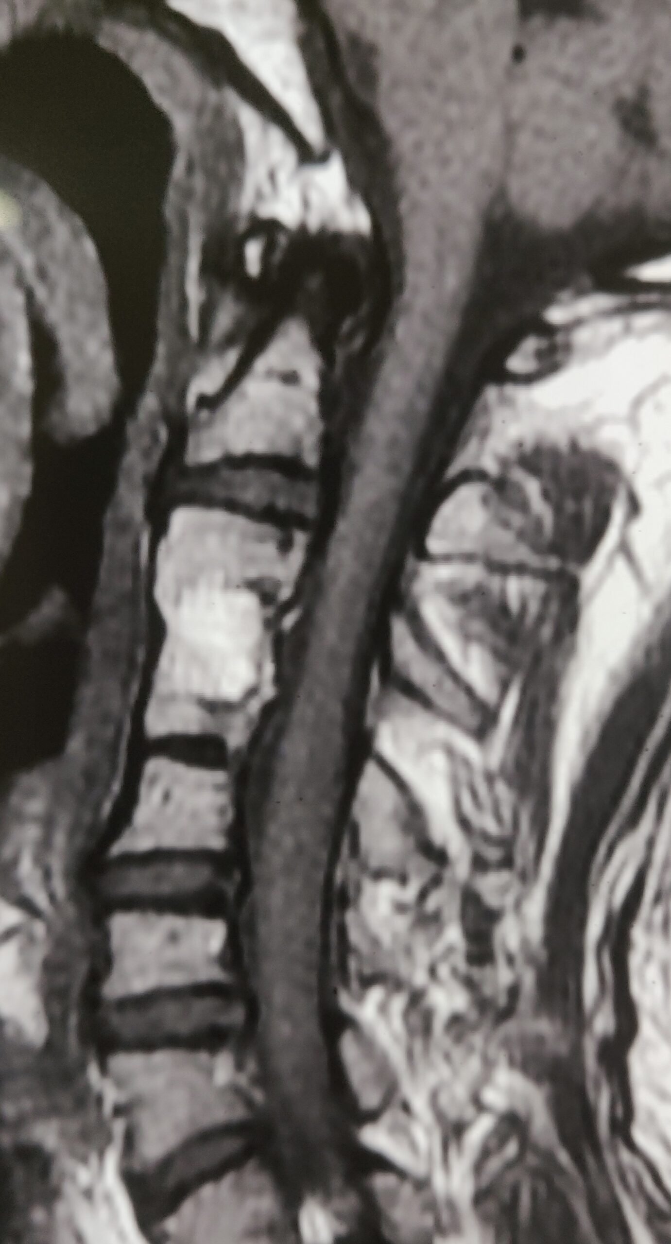Post Operative MRI Showing relief to cord compression