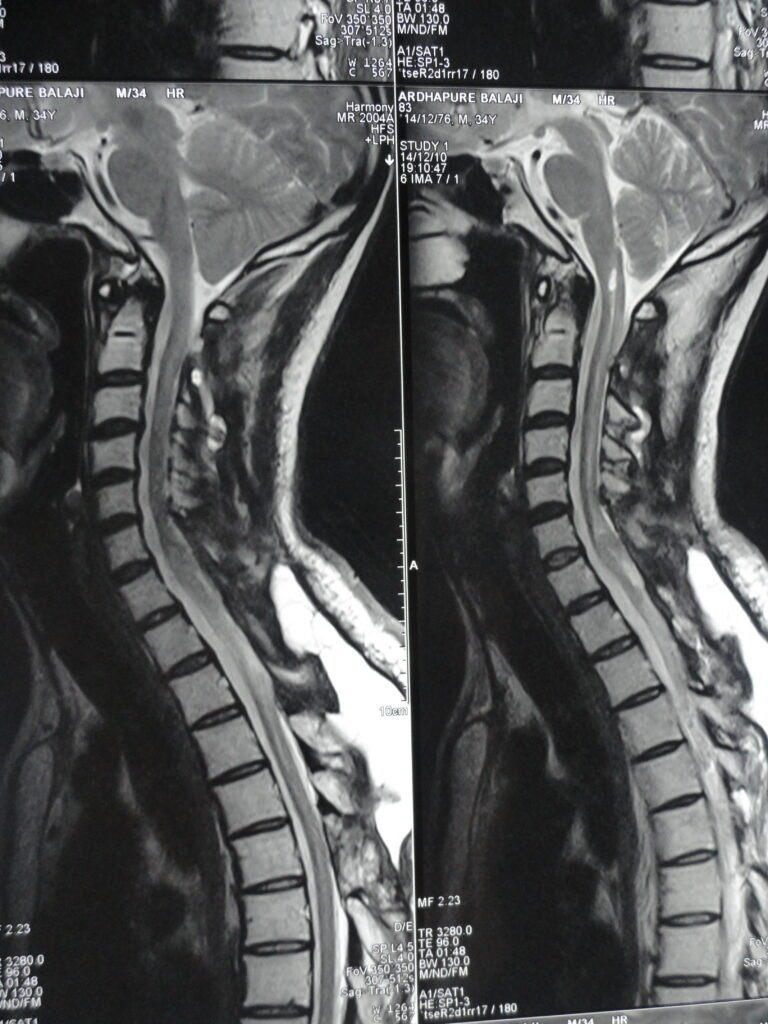 MRI After surgery