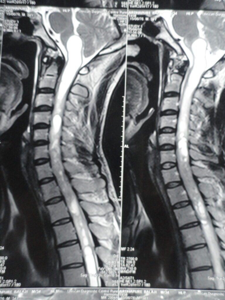 SPINAL cord TUMOR in cervical region