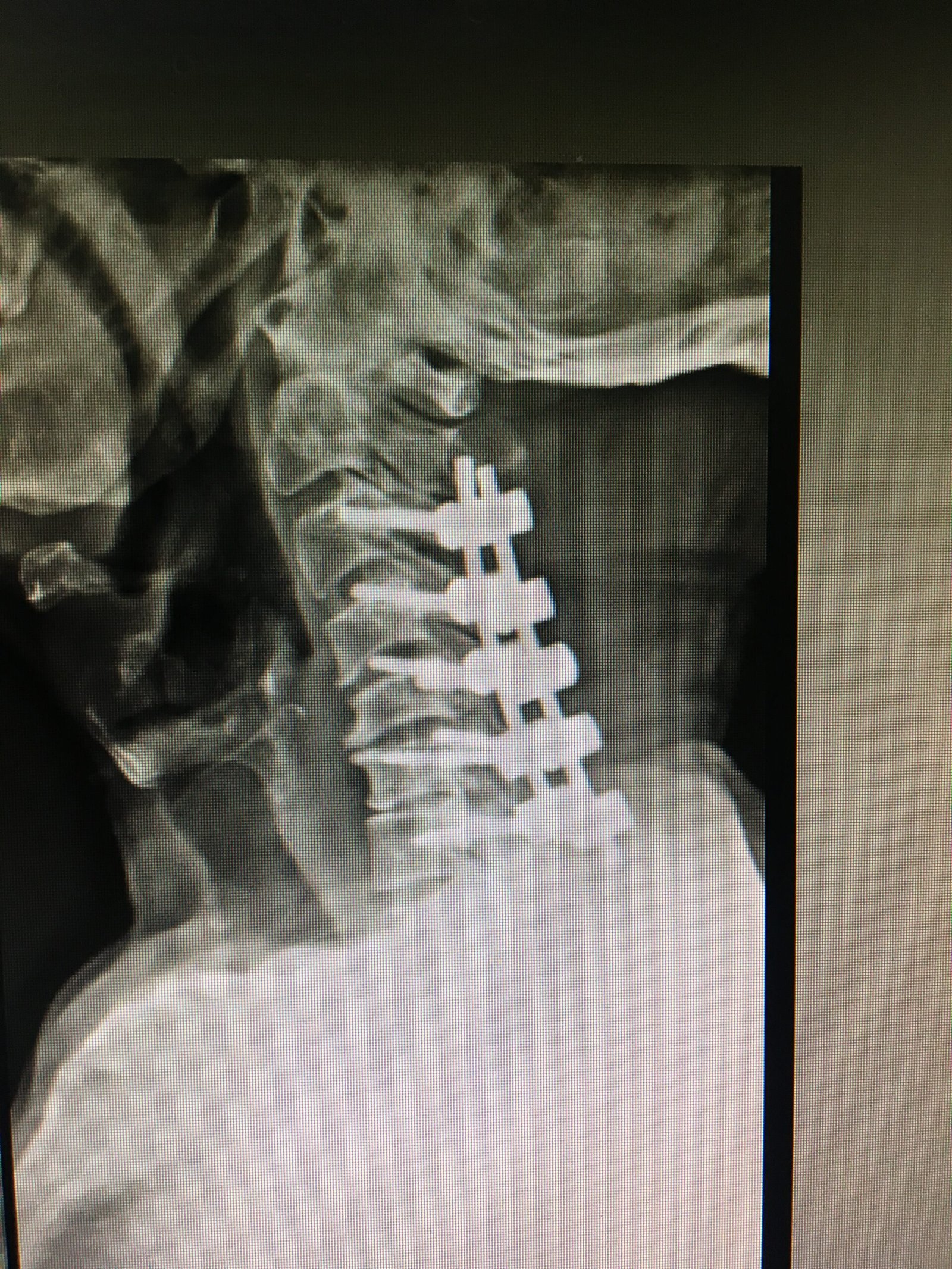 Cervical Spondylosis Decompression and Stabilization Done