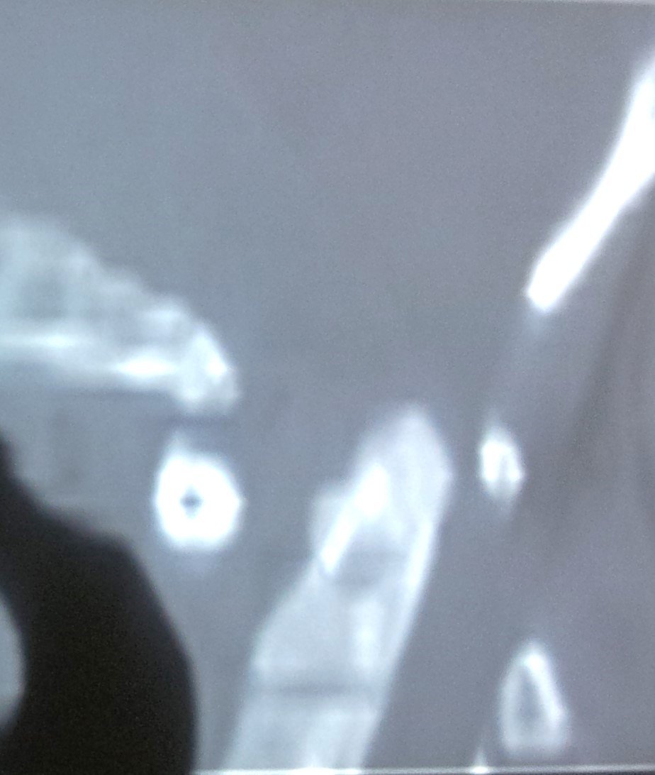 atlanto axial dislocation ct scan