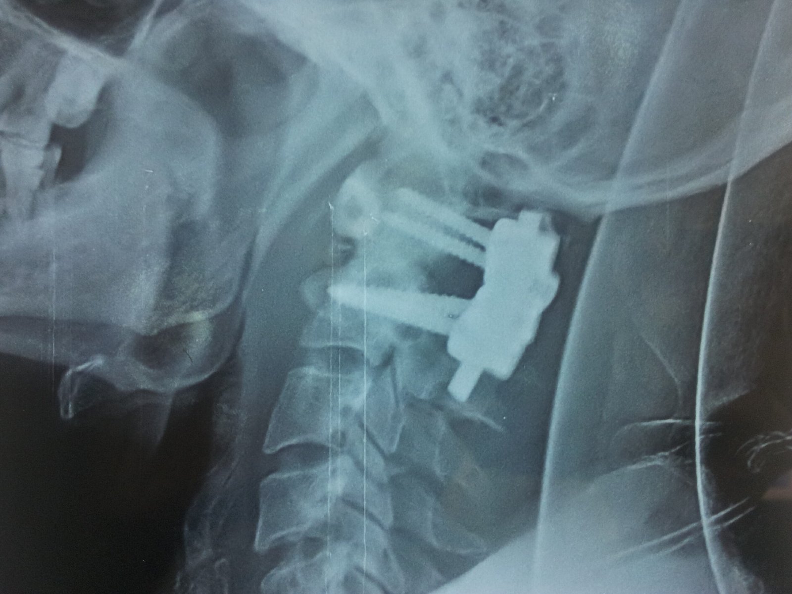 Postoperative correction