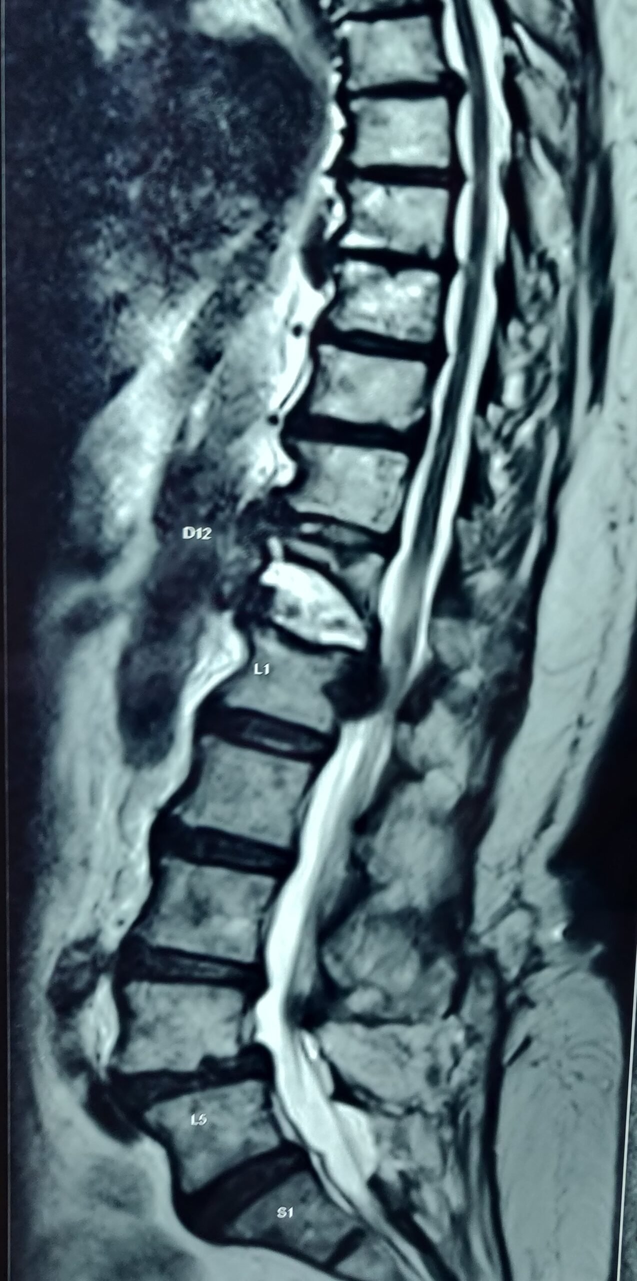 D12 spine compression fracture