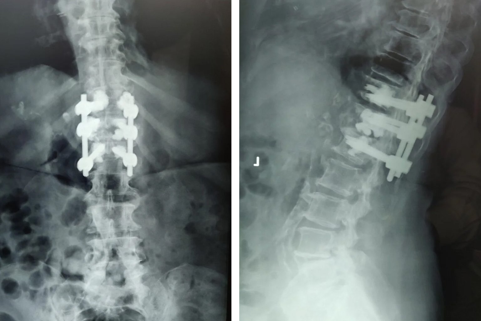 compression fracture stabilization surgery done