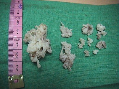 dISC mATERIAL rEMOVED fROM l4-l5 DISC SURGERY