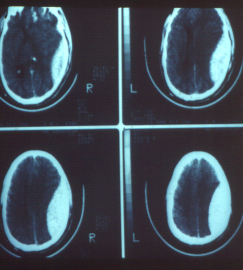 Extradural Haematoma
