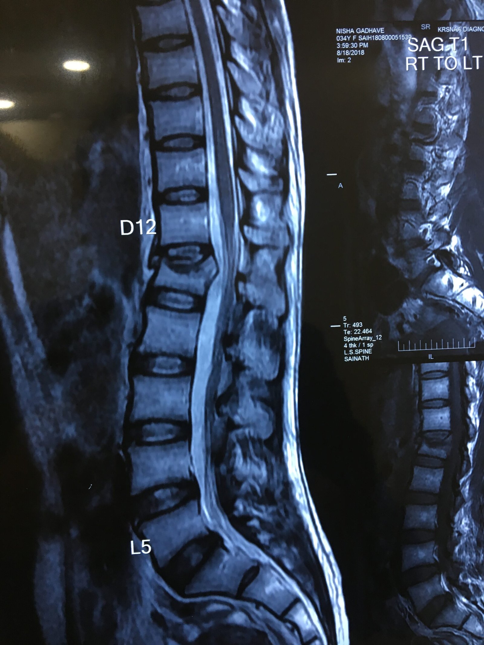 Fracture of L-1 body