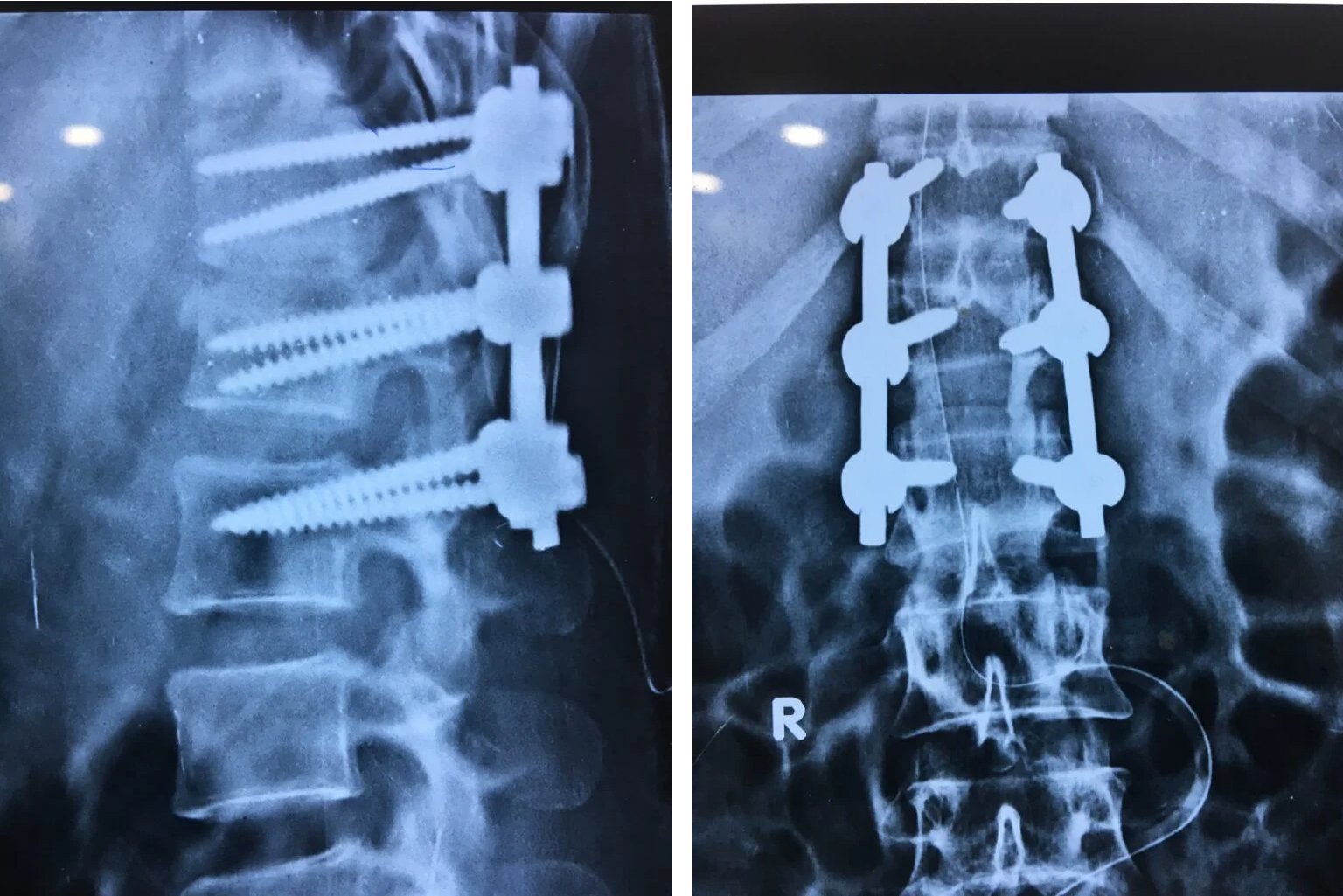 Correction of fracture & Stabilization of L-1 Body Fracture