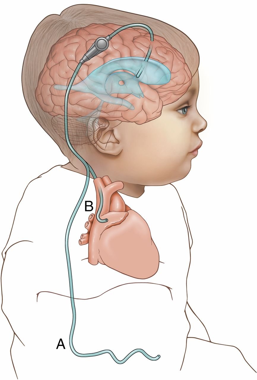 Ventricular Enlargement in Hydrocephalus