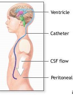 Ventriculoparitonial Shunt for Hydrocephalus