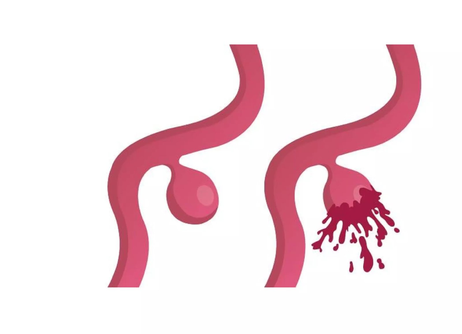 Brain Aneurym rupture scaled