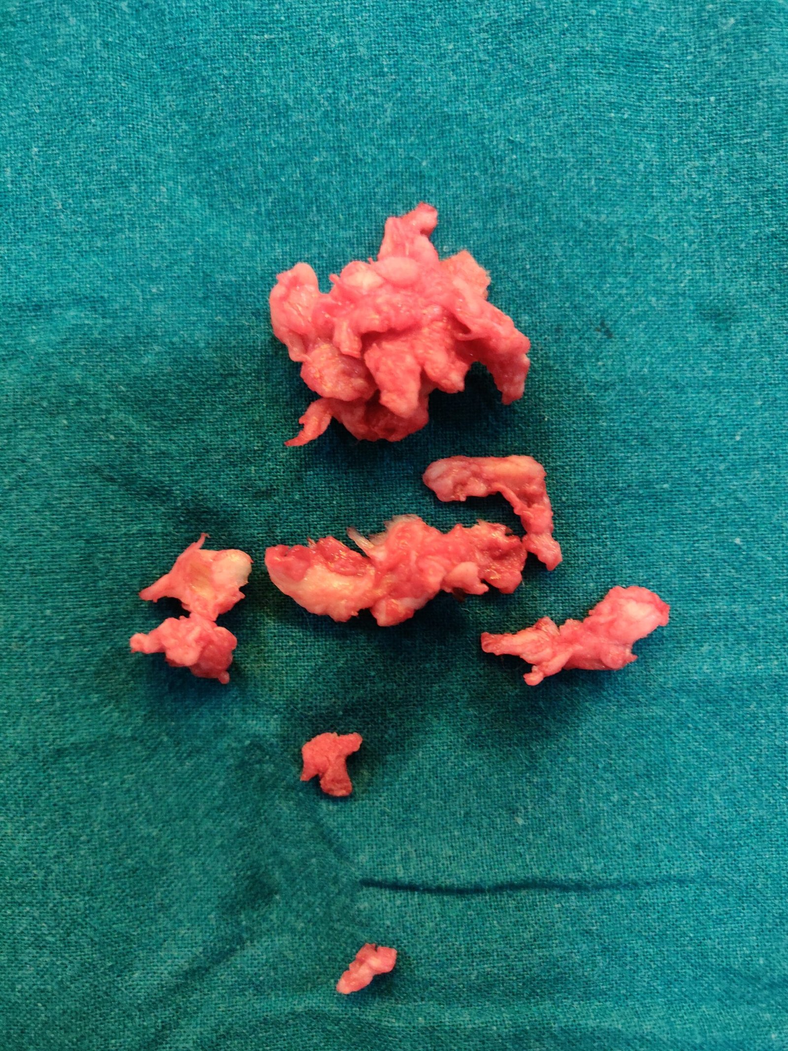 lumbar disc Removed through endoscopy