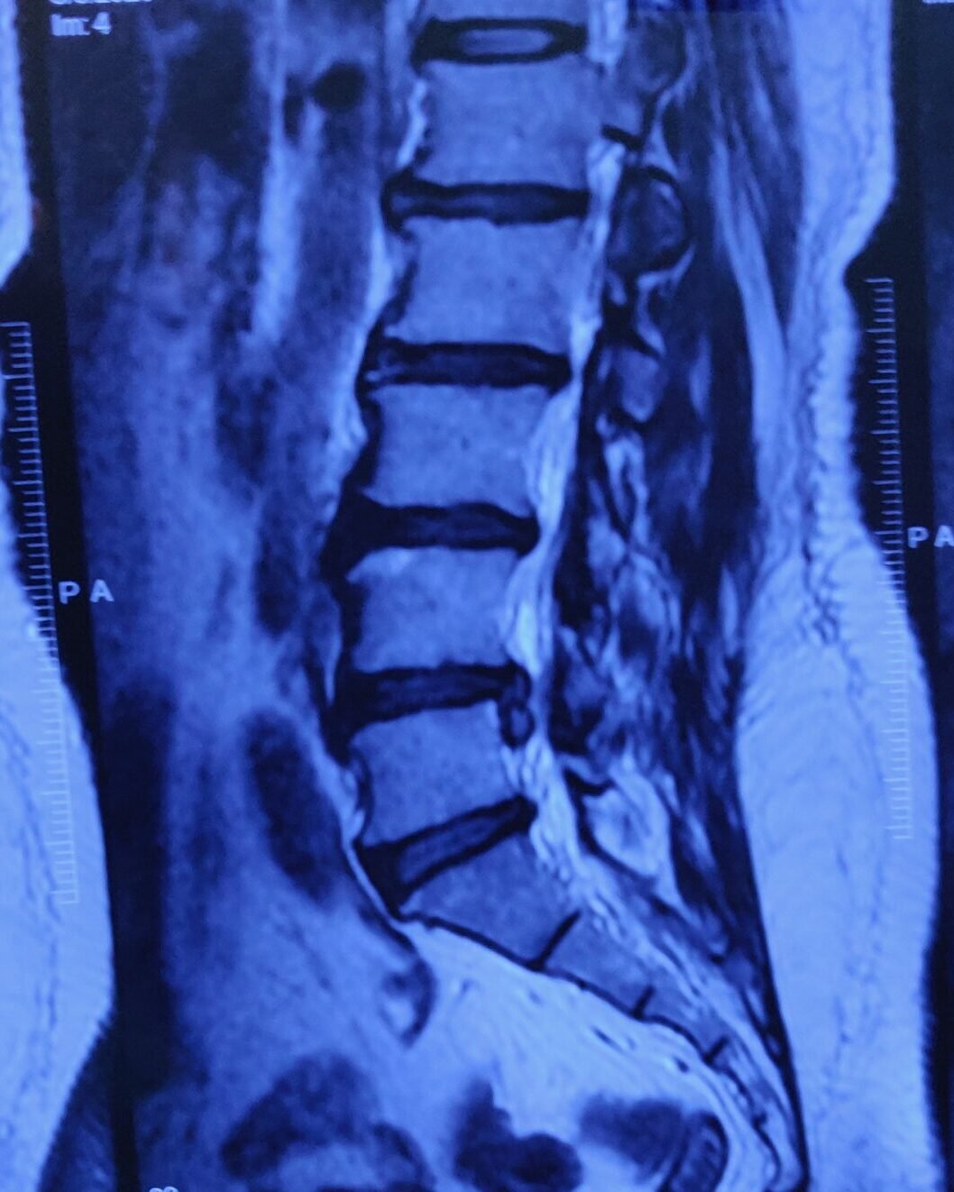 l4/l5 disc prolapse