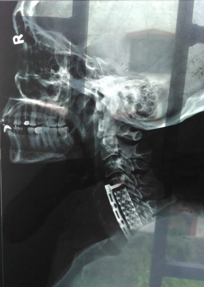 Decompression and stabilization of OPLL done