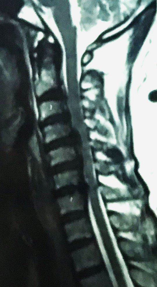 Ossified Posterior Longitudinal Ligament (Opll) causing compression of spinal cord