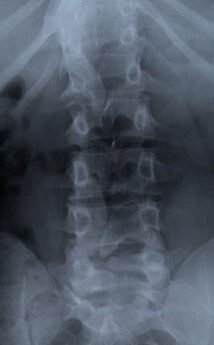 Spina Bifida Spinal Dysraphism