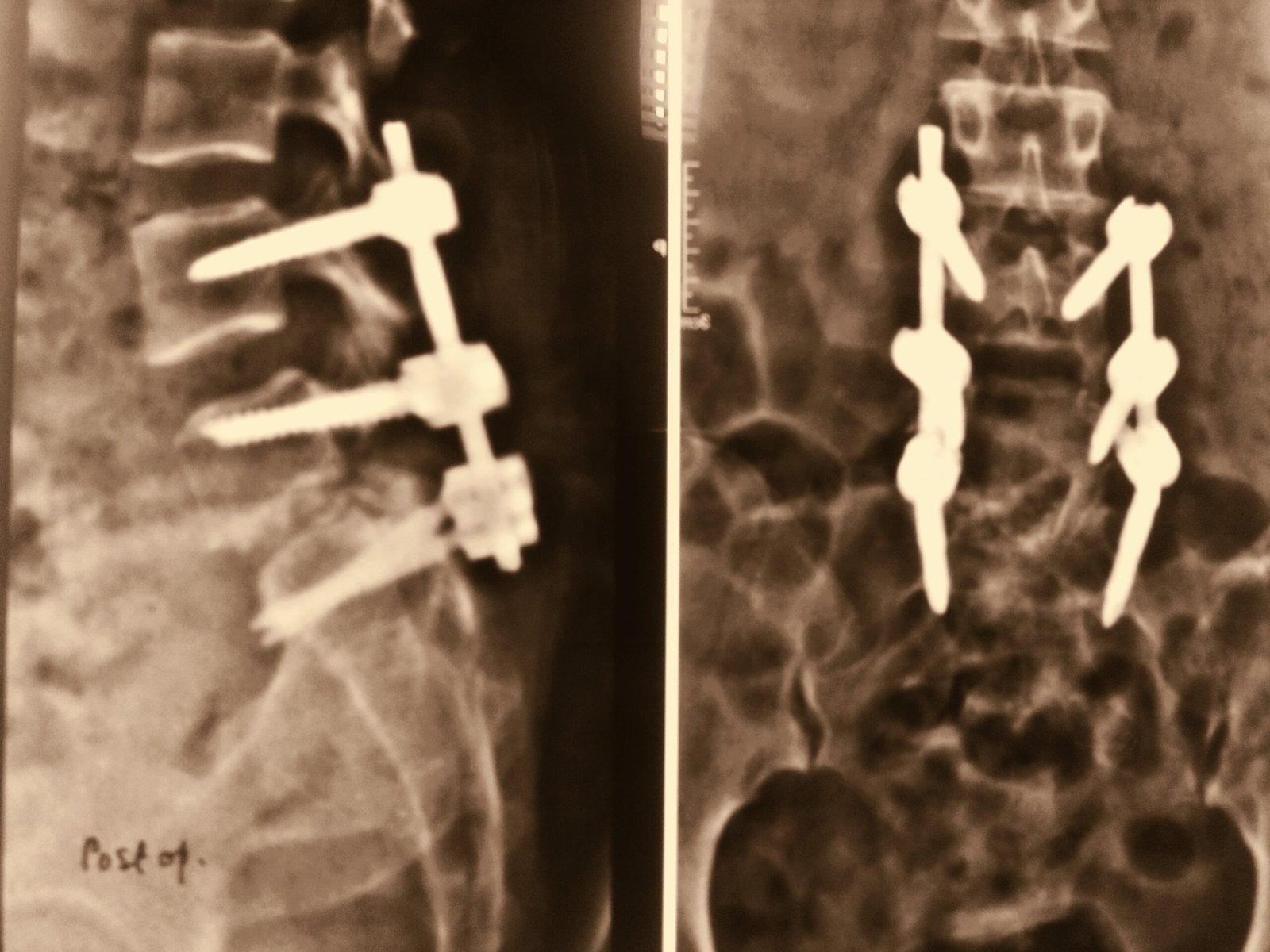 cORRECTION OF Spondylolisthesis BY sURGICAL sTABILIZATION