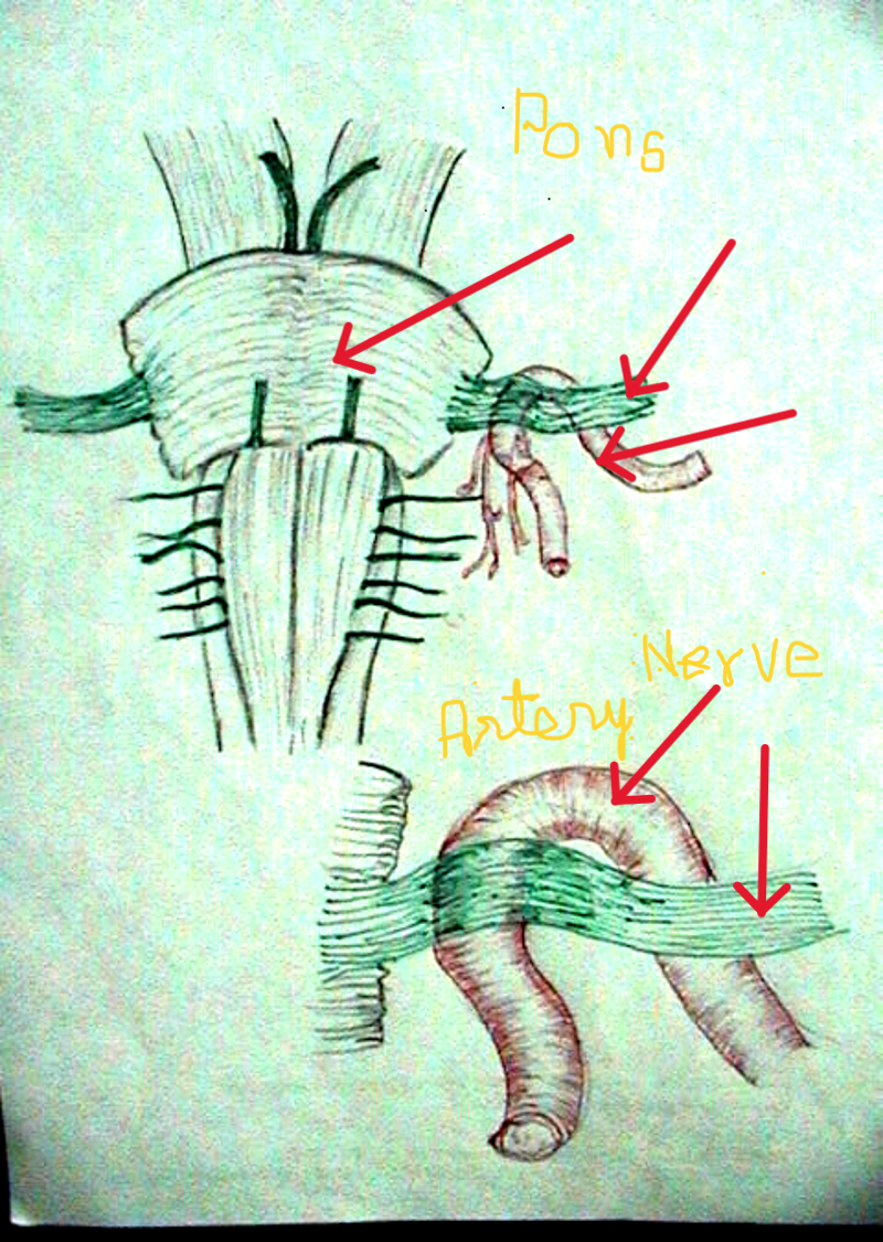 Nerve compression by an artery in trigeminal neuralgia